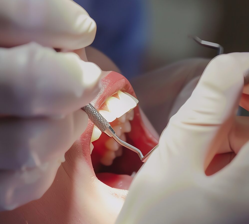 Endodontics West Chester, Ohio